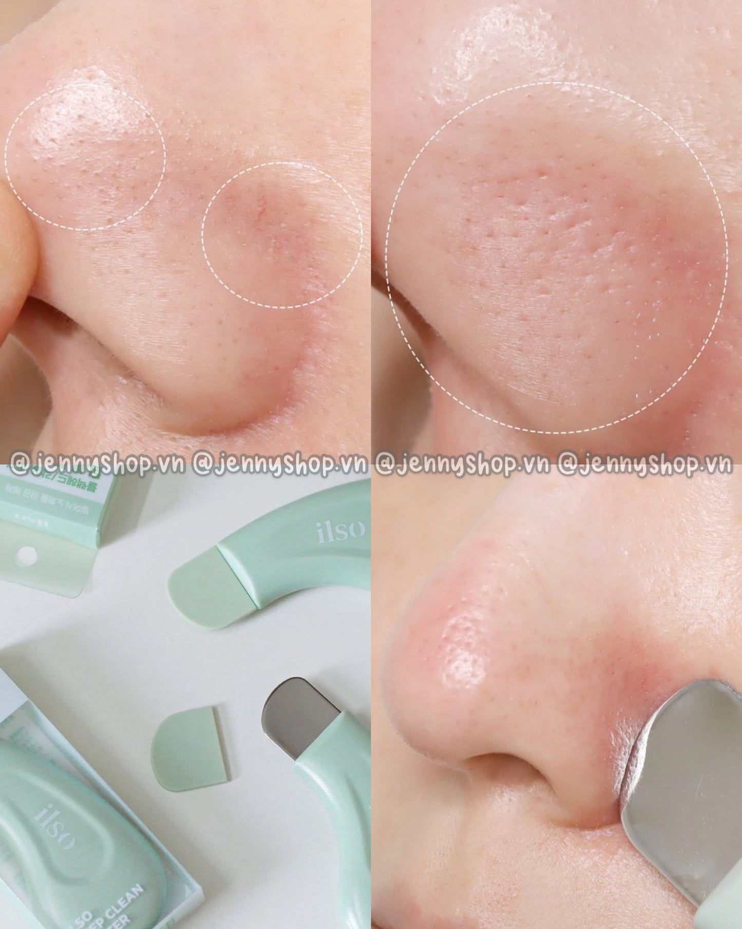 ILSO - Blackhead Remover Single Product Option Deep Clean Master
