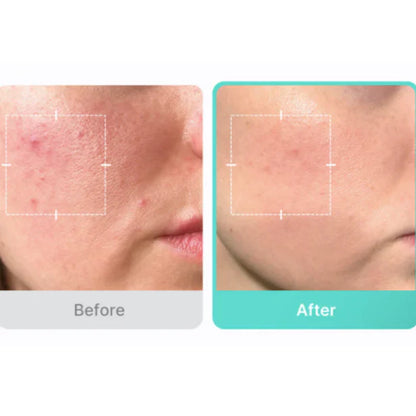 MEDICUBE - AZELAIC ACID 16 BB CALMING SERUM 30ml